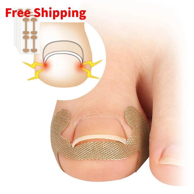 4Pcs Ingrown Toenail Correction Stickers: Adhesive Nail Patch - ClubOn