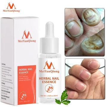 Instant 30ml Rotten Nail Essence Serum for Foot Care & Repair - ClubOn