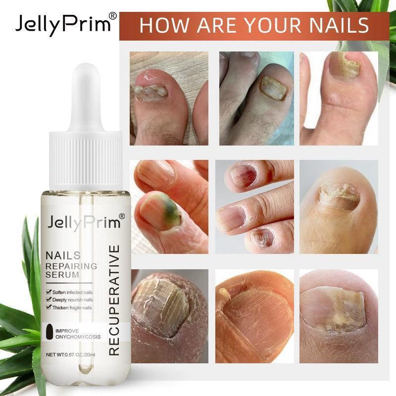 Nail Fungus Treatment Gel - Restores Healthy Nails & Care - ClubOn