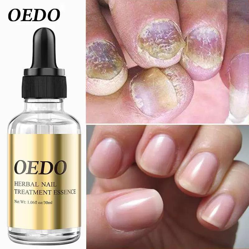 Fungal Nail Treatment Essential Oil for Hands and Feet - ClubOn