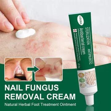 Herbal Foot Fungus Removal Cream - Nail Care & Anti-Fungal Treatment - ClubOn