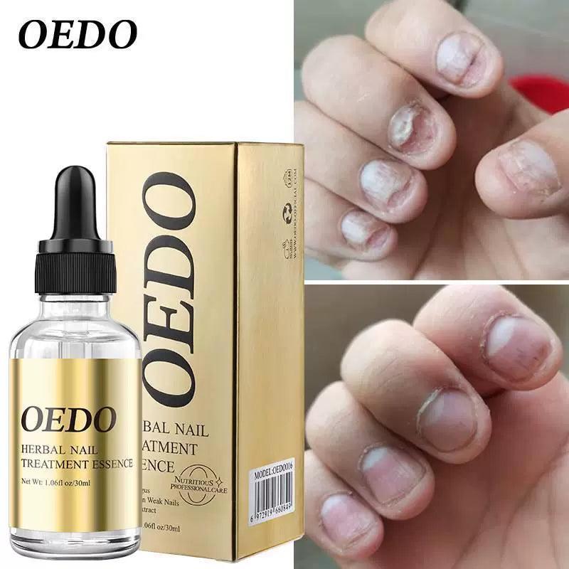 Fungal Nail Treatment Essential Oil for Hands and Feet - ClubOn