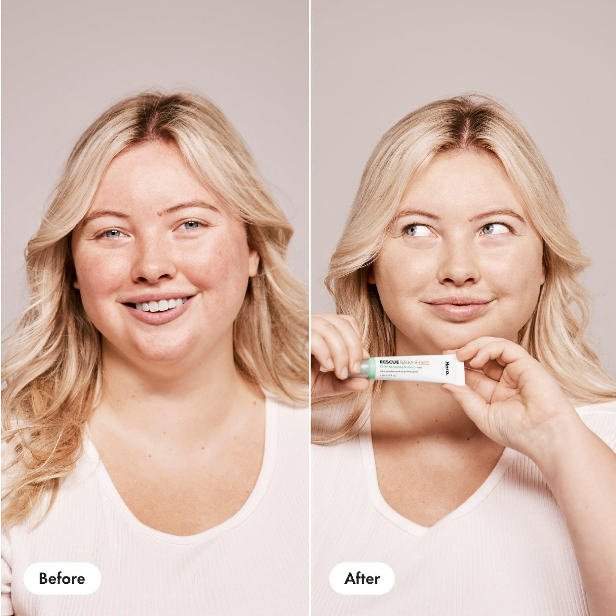 Hero Cosmetics Rescue Balm +Red Correct – Post-Blemish Recovery Cream for Blemish-Prone Skin, 15ml - ClubOn